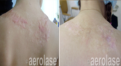 Before and after view of a person's back; scar tissue treatment.