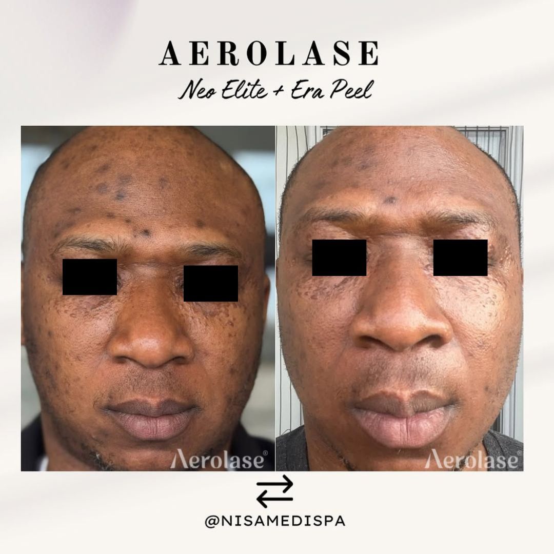 Before and after facial skin treatment using Aerolase Neo Elite + Era Peel.