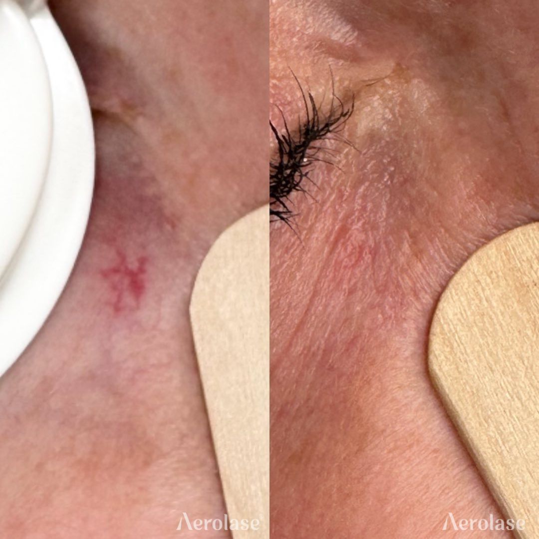 Before and after comparison: skin with a red, spider vein; after treatment, the vein is gone.