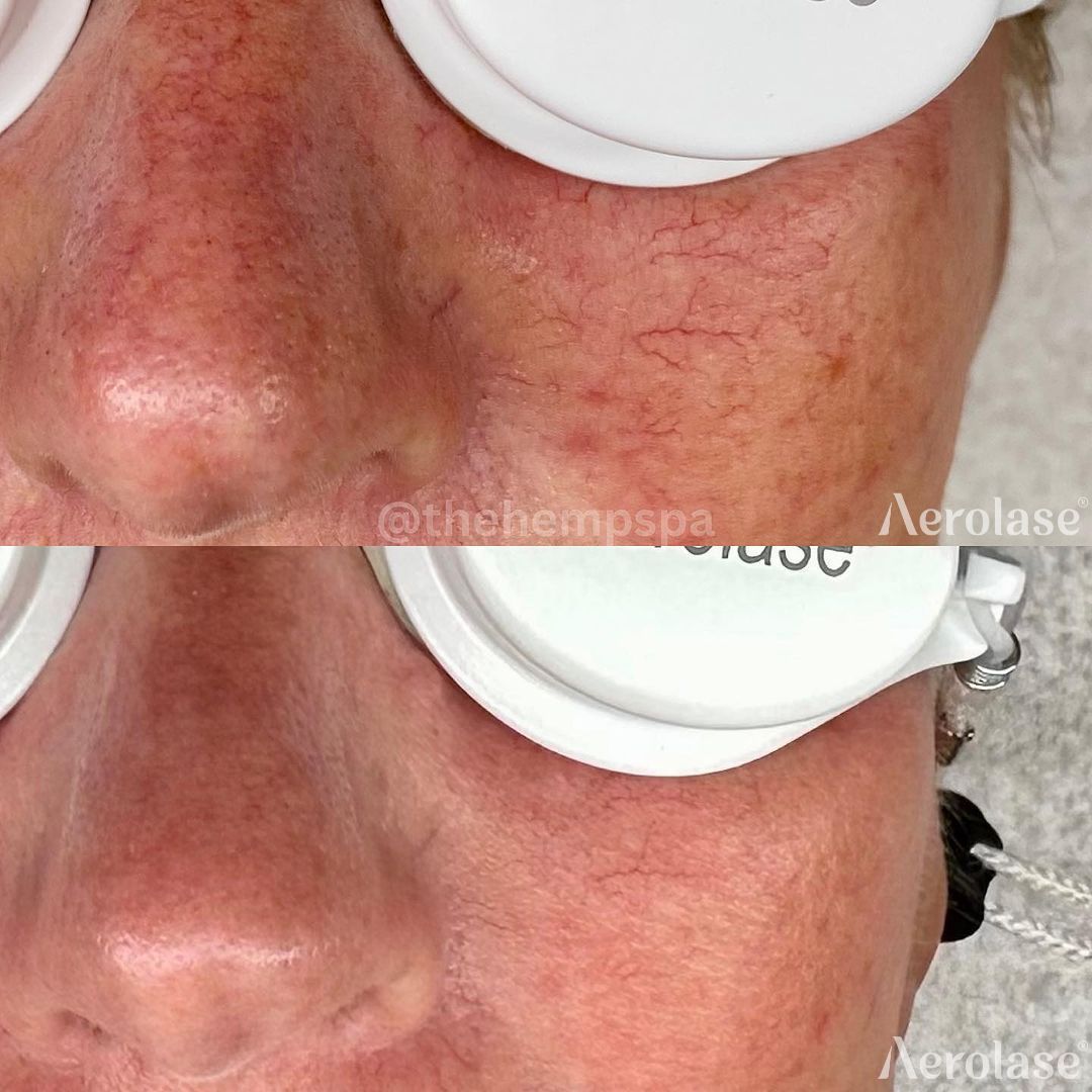 Two close-up photos of a person's face. Top photo shows visible facial veins. Bottom photo shows reduced veins after laser treatment.