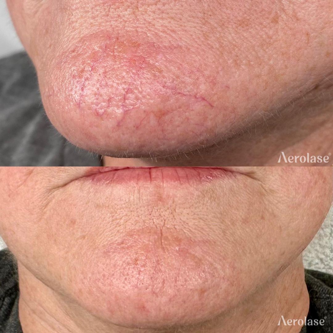 Before-and-after of a chin, with visible veins reduced post-laser treatment.
