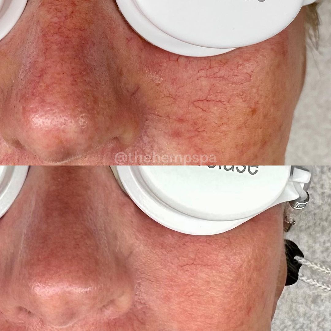 Side-by-side comparison of a person's abdomen, before and after stretch mark treatment with Aerolase laser.