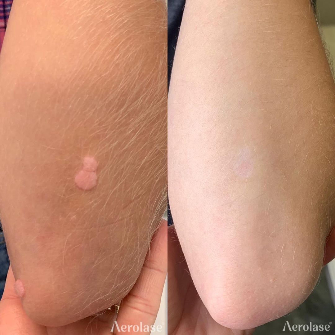 Before and after view of a skin lesion on the elbow, showing reduction after treatment.
