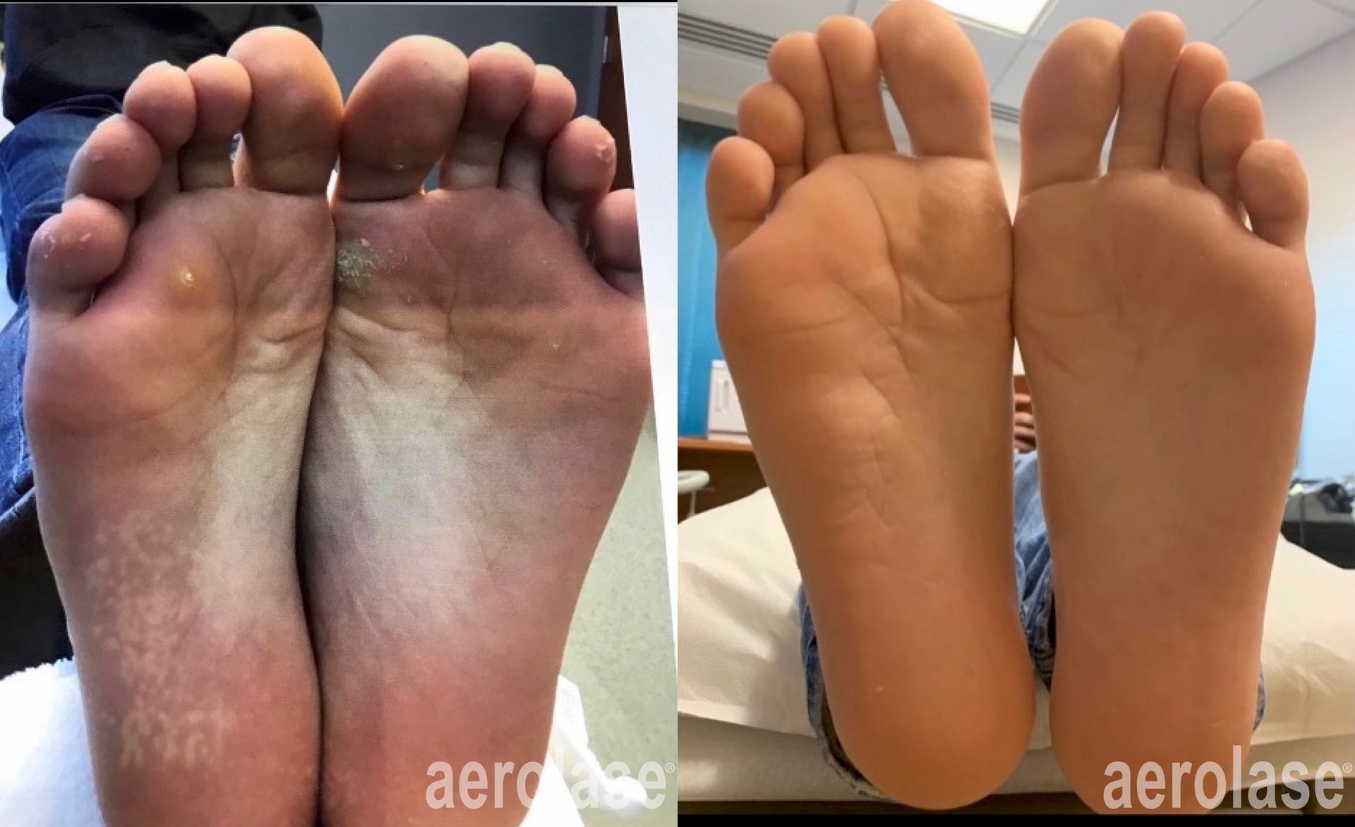 Two foot soles: Left, skin discoloration; Right, healthy skin after treatment.