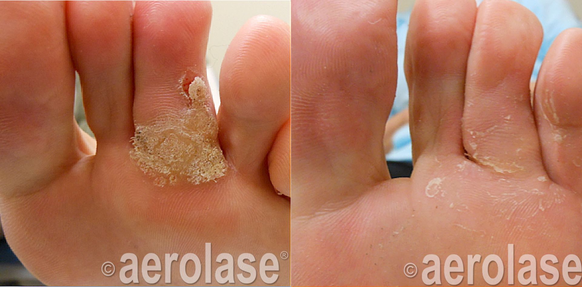 Before and after treatment of a foot with a wart between the toes.