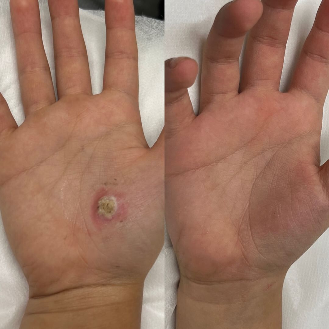Hand before and after healing, showing a wound and its resolution.