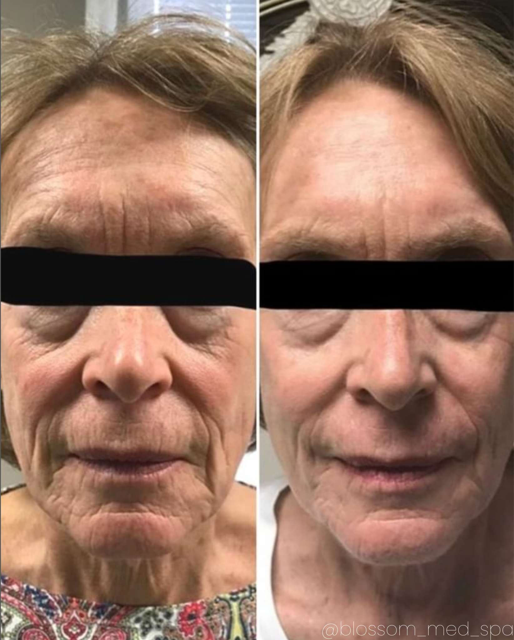 Two side-by-side facial photos, before and after a procedure, showing reduced wrinkles around the eyes and forehead.
