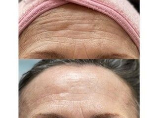 Forehead comparison: wrinkled skin before, smoother skin after a procedure.