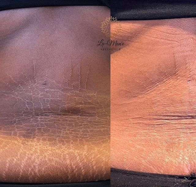 Before and after abdominal stretch marks treatment; darker skin with lines fading.