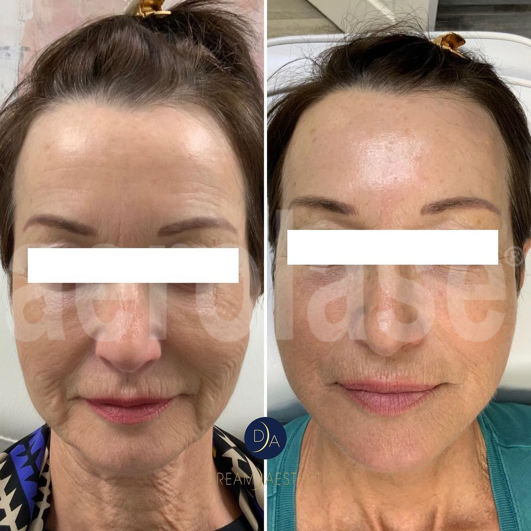 Before and after facial rejuvenation photos showing reduced wrinkles and improved skin tone.