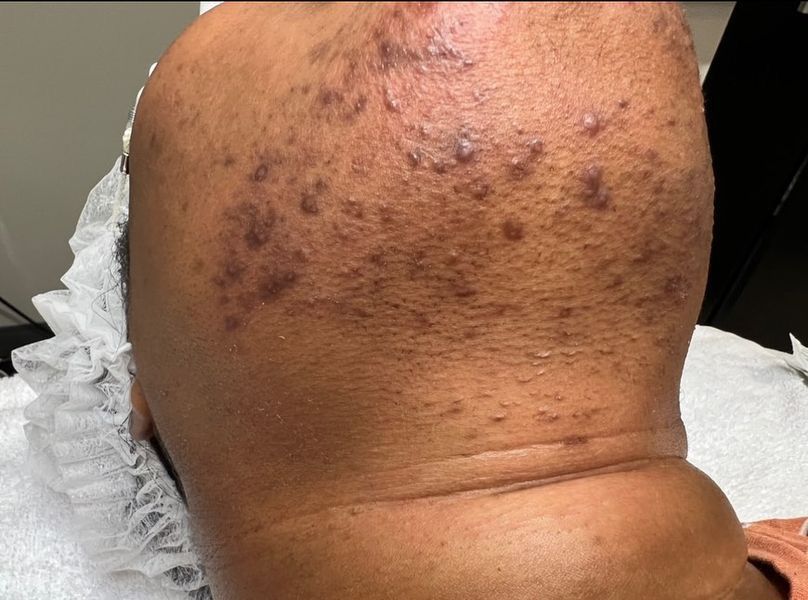 Close-up of a person's neck with multiple bumps and discoloration. Light-colored head covering is visible.