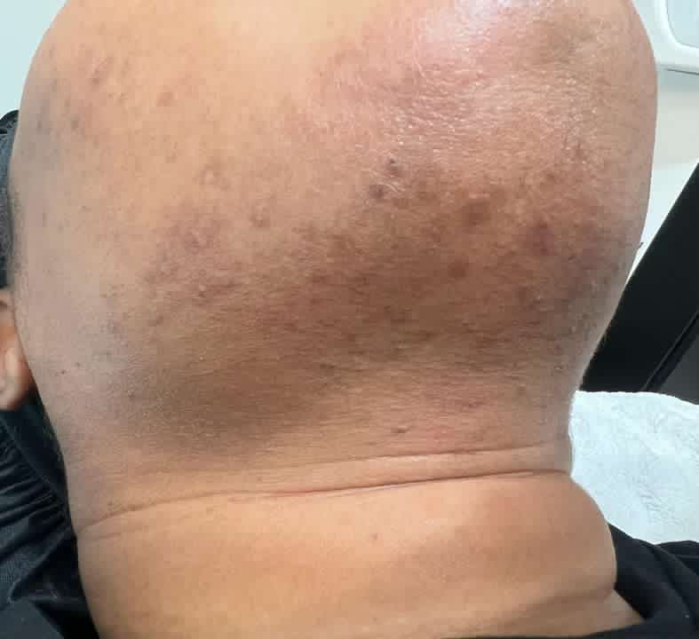 Back of a person's head and neck, showing uneven skin tone with several dark spots.