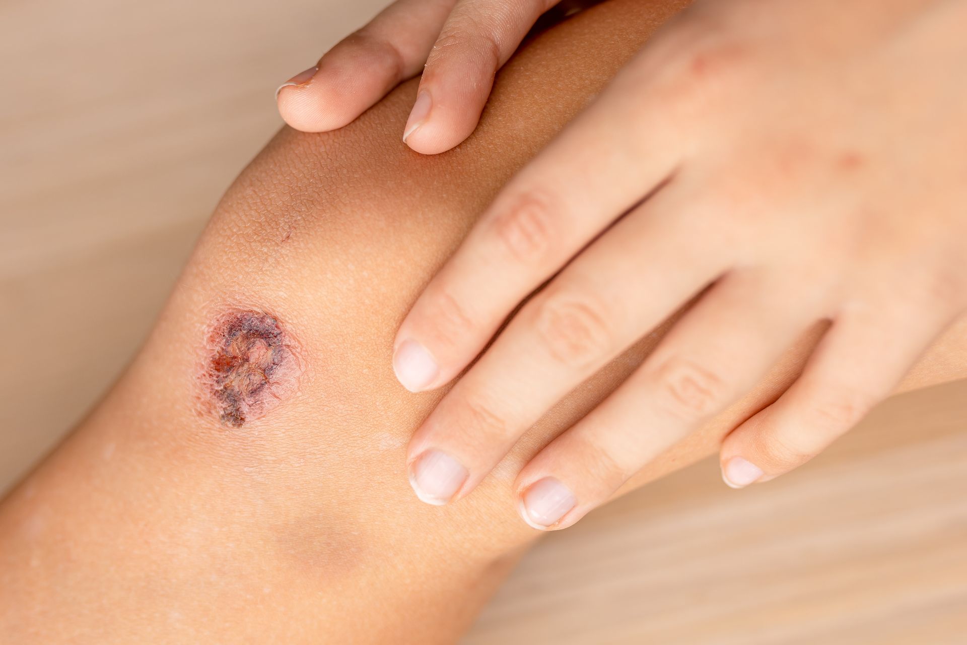 Knee with a scrape; a hand is gently touching the wounded area.