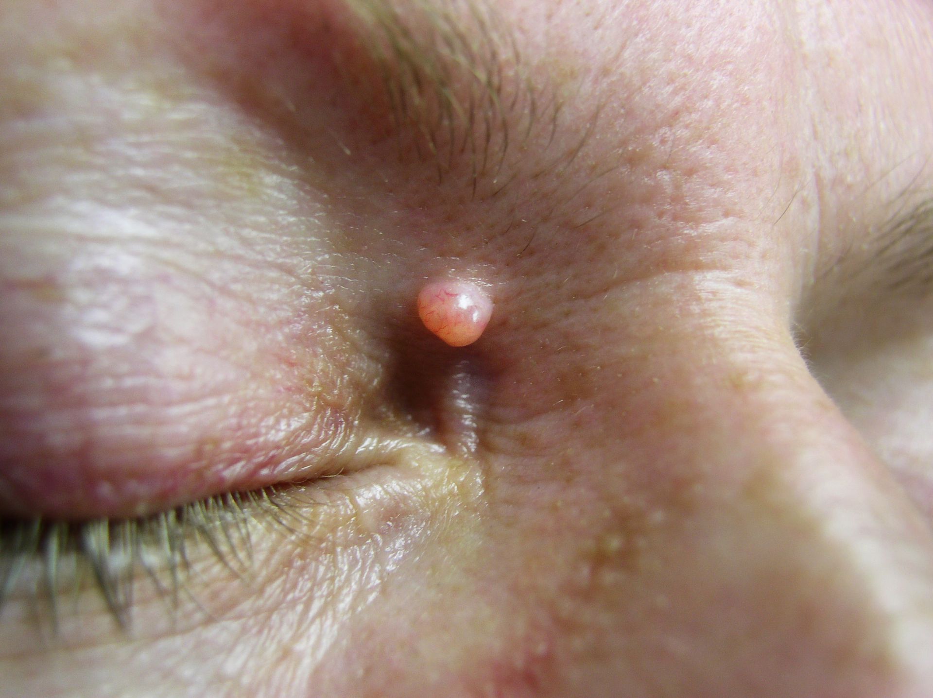 Close-up of a person's eye with a small, pink, raised lesion near the tear duct.