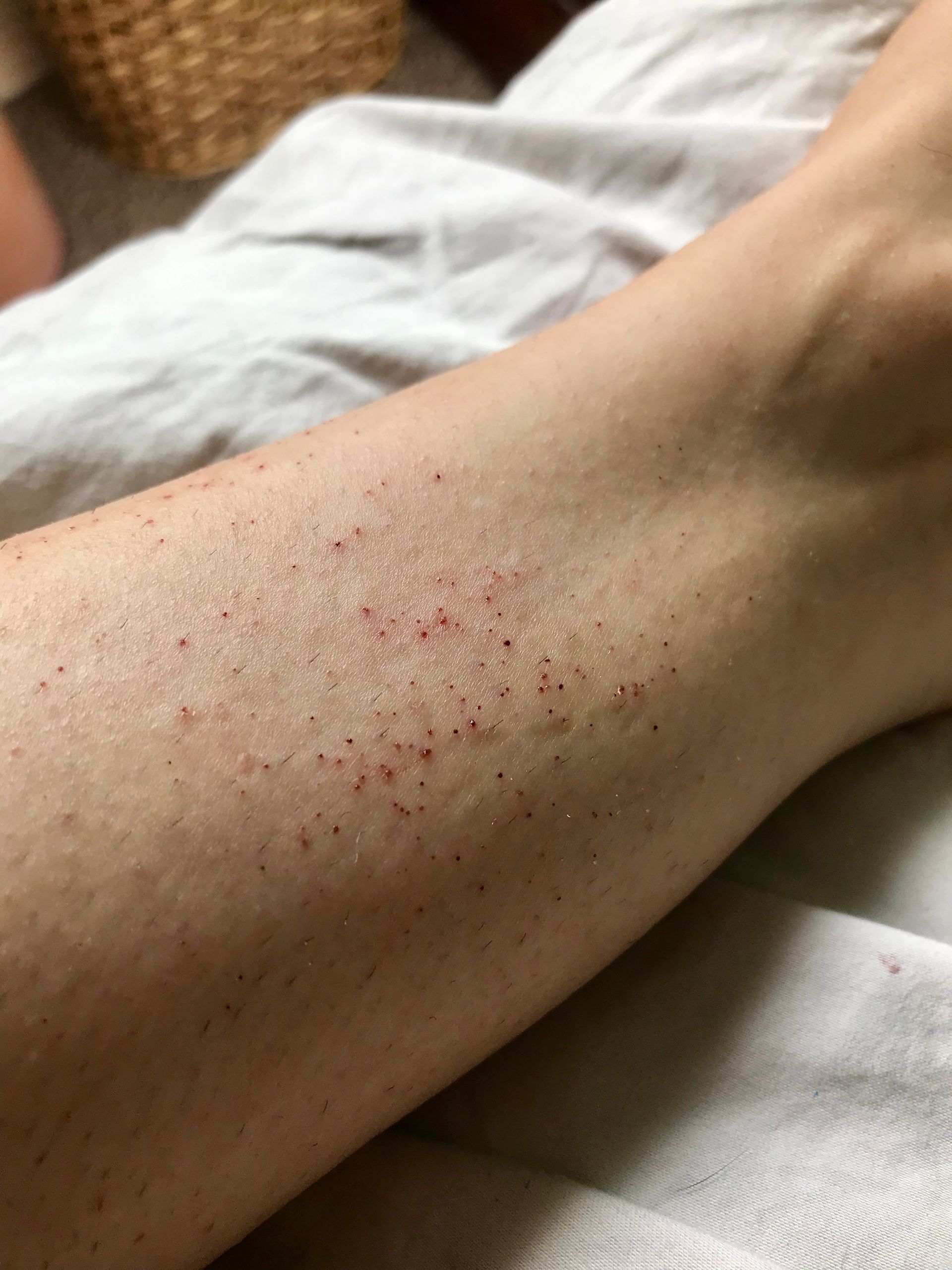 Leg with small red dots, possibly a rash or irritation.