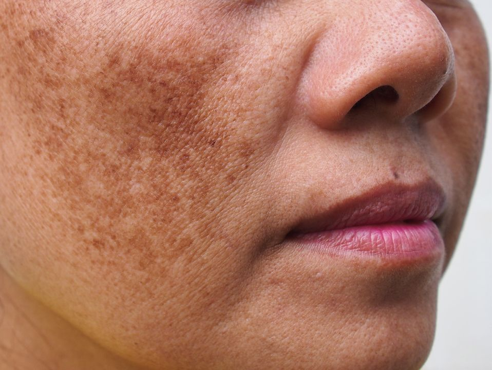 Close-up of a person's face with noticeable brown skin discoloration on the cheek.