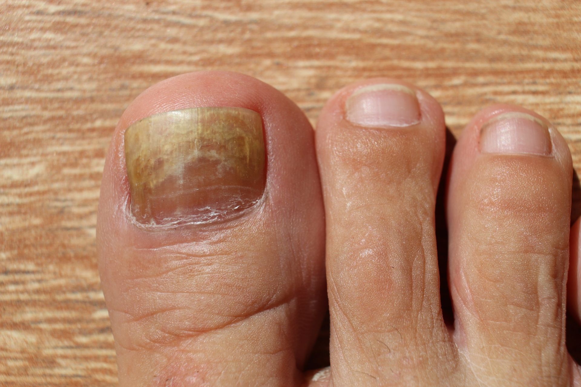 Toe with a yellowed, thick toenail, potentially indicating a fungal infection.