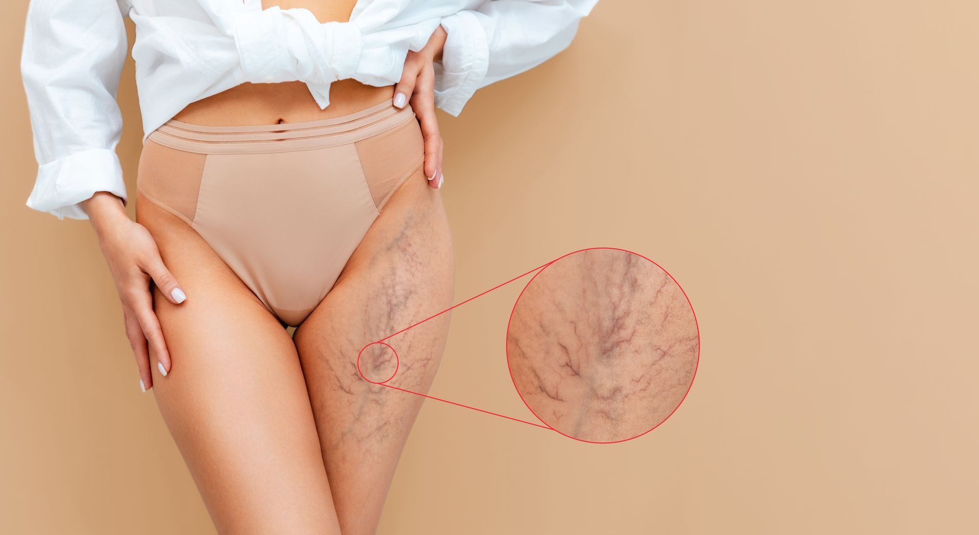 Woman with visible spider veins on inner thigh, a close-up shows the detailed view.