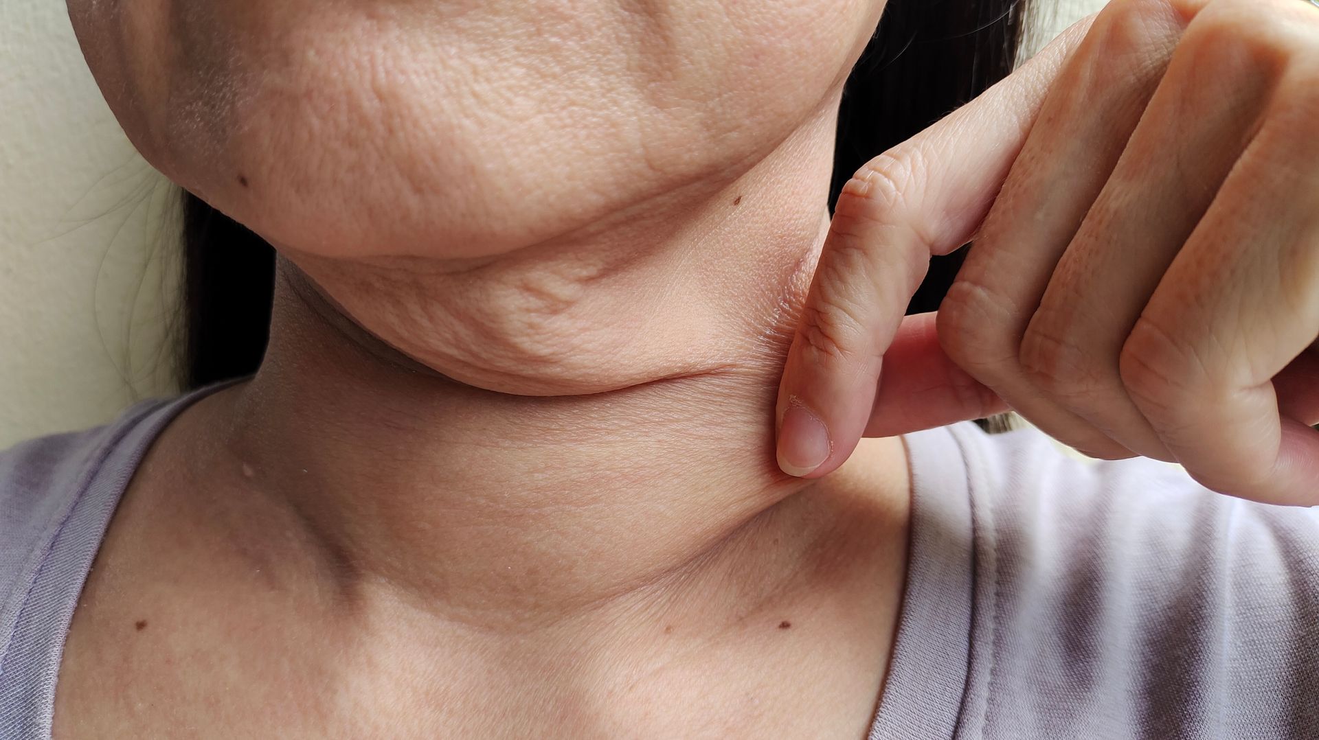 Person pointing at their neck. Visible double chin and swollen area around the neck.