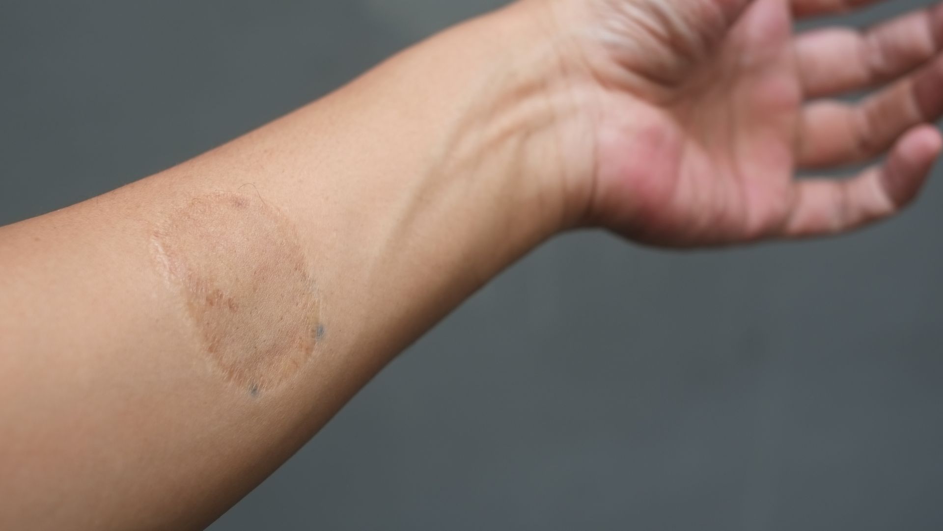 Arm with a brown, circular skin discoloration on the forearm, against a gray background.
