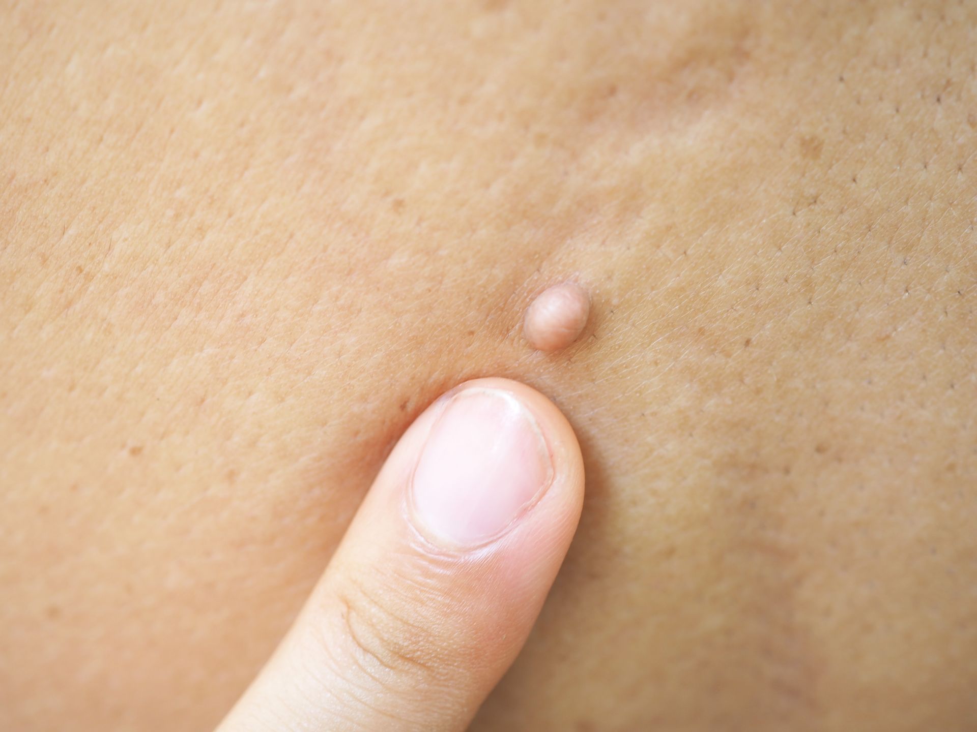 Finger pointing at a small, tan skin growth on light-toned skin.