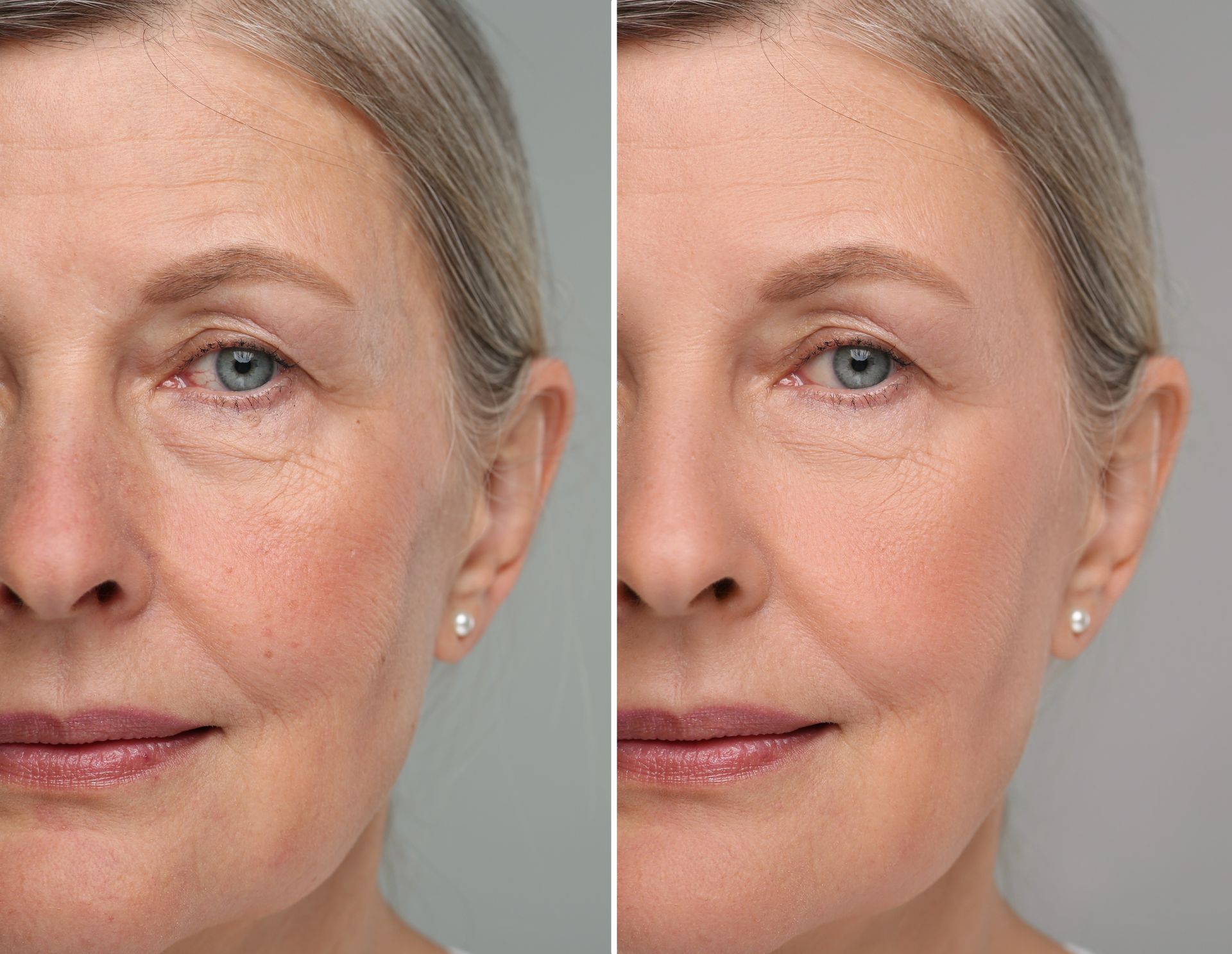 A before and after photo of an older woman 's face.