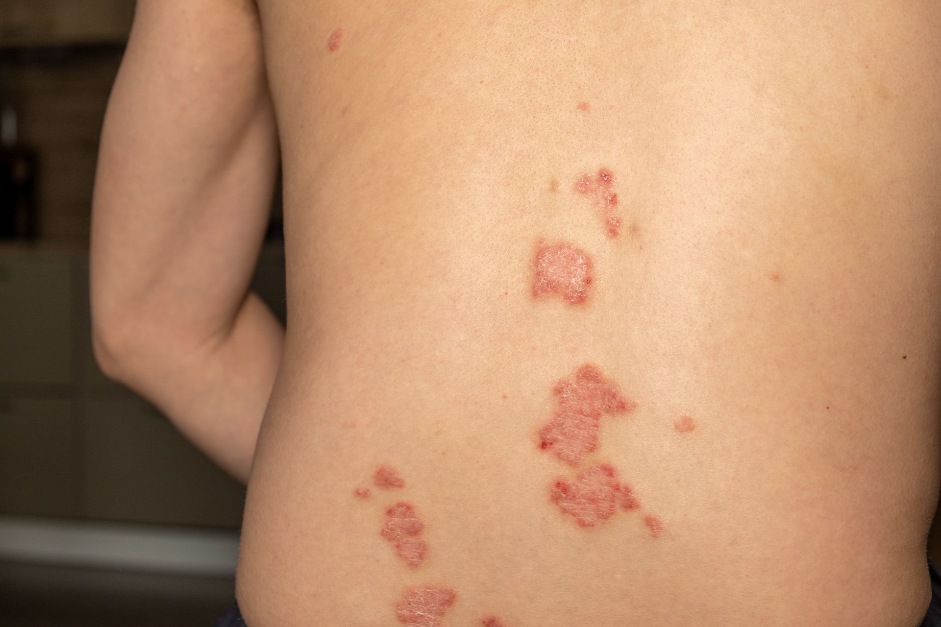Skin rash on a person's back, clusters of red, irritated patches along one side.