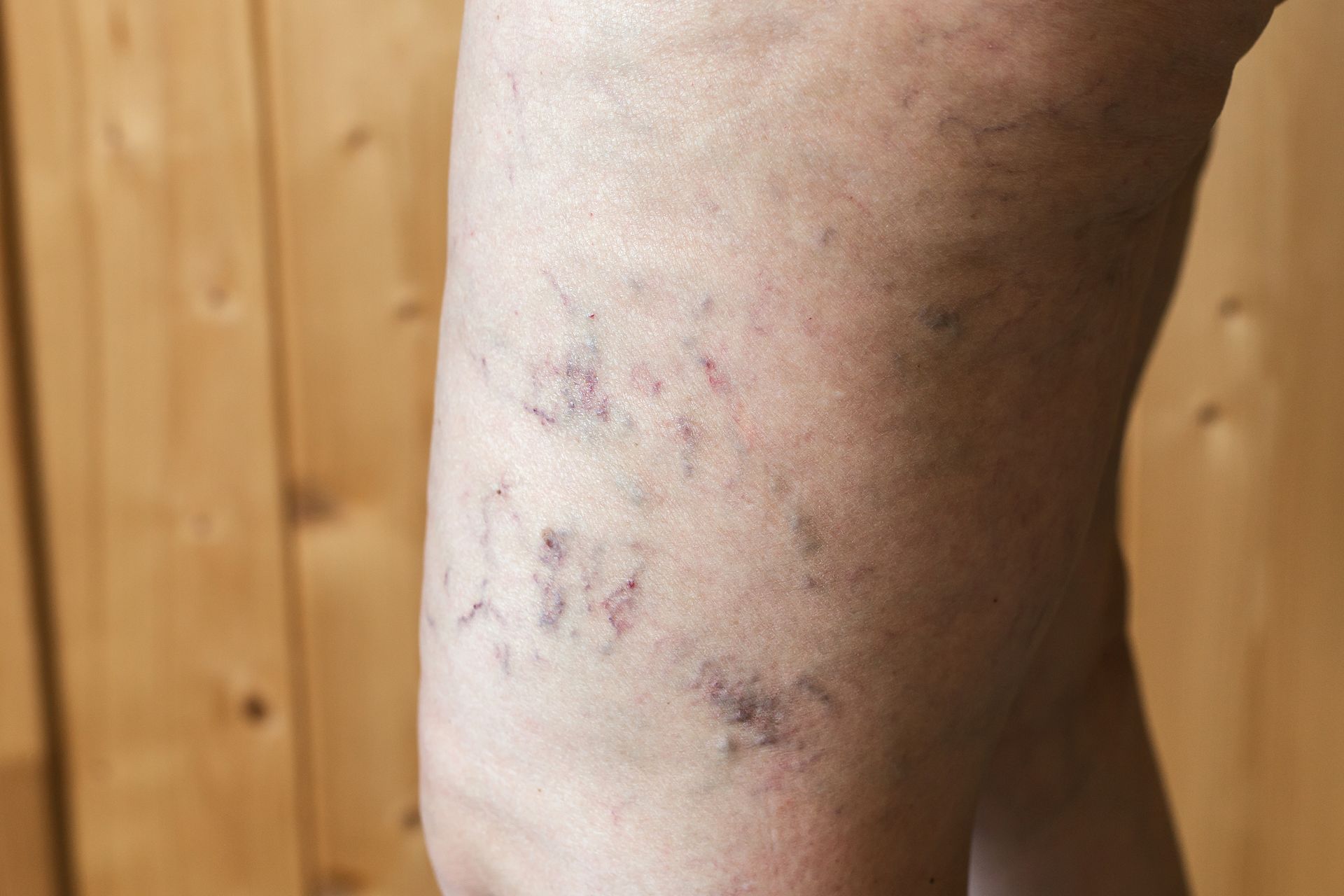 Leg with visible spider veins against a wooden background.