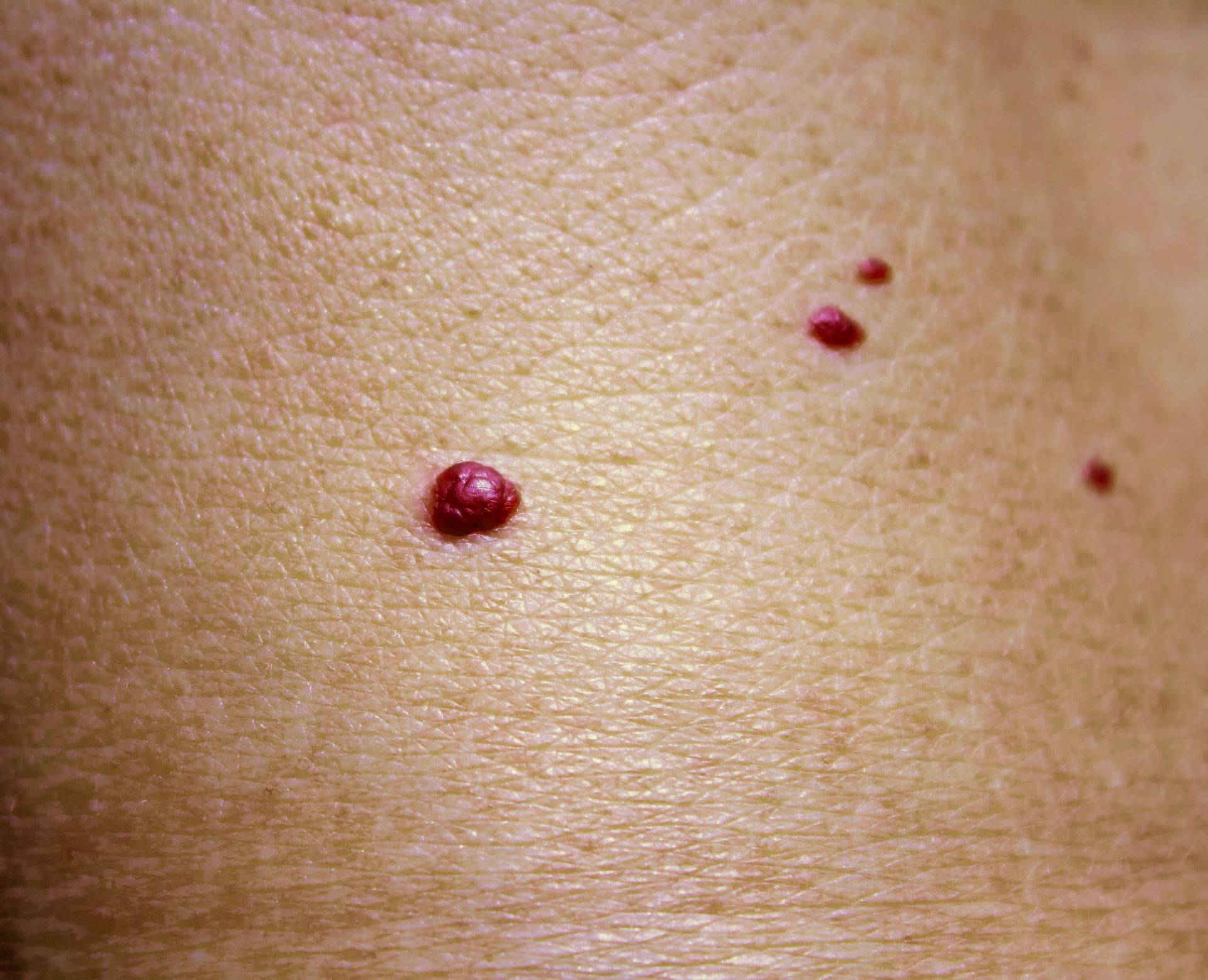 Skin with several small, raised, bright red spots; possibly angiomas.