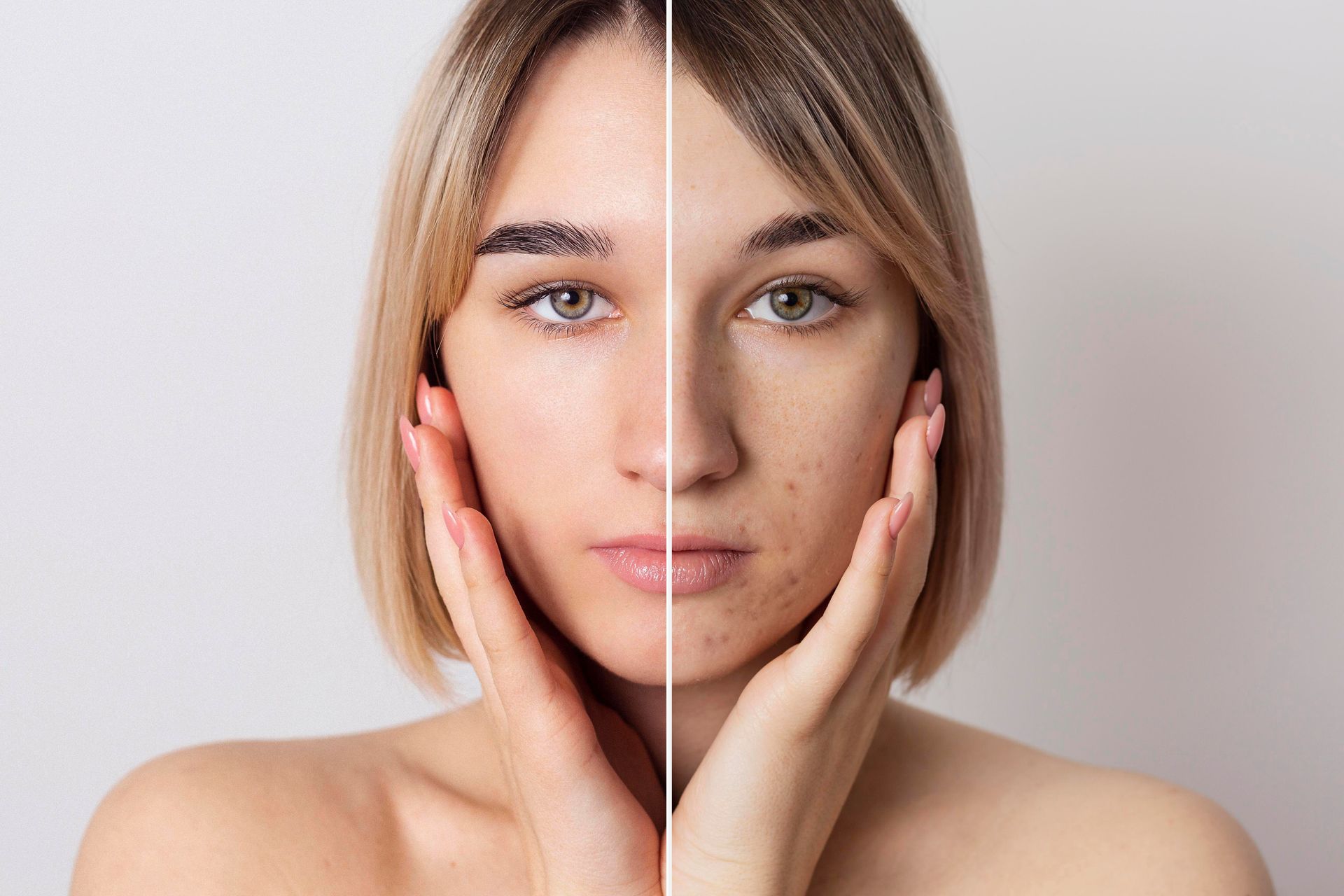 before and after picture of woman with acne