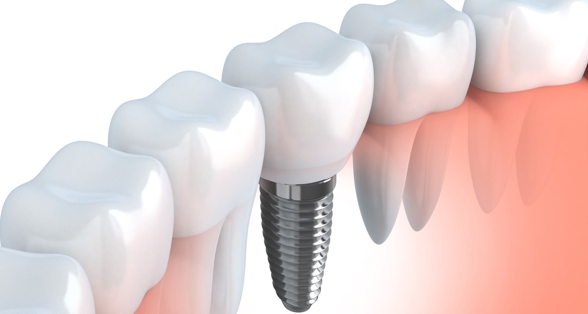 model of teeth and a dental implant