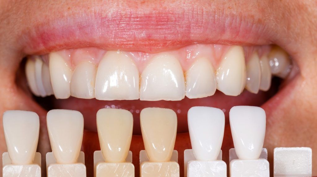 closeup of persons mouth with color matching swatches for veneers