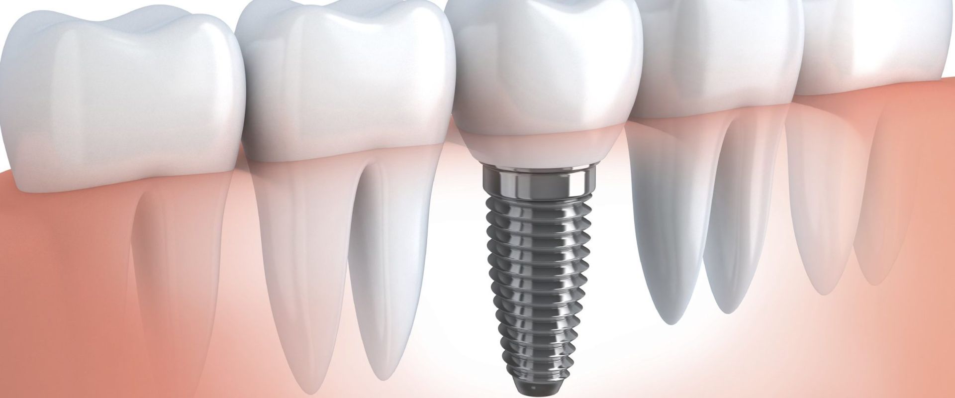 model of teeth showing a dental implant for implant restoration