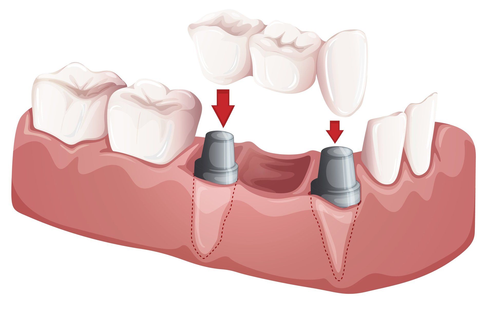 model of a dental bridge for bridges procedures