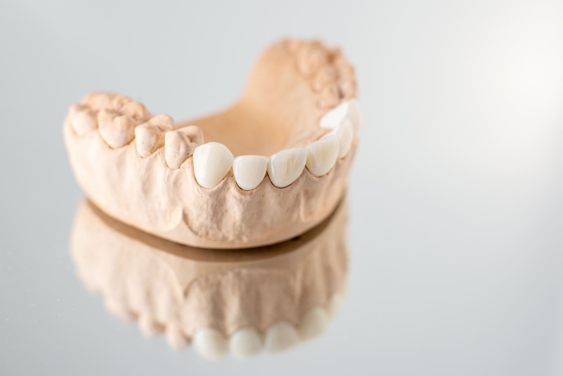 veneers on a model of the bottom jaw and teeth