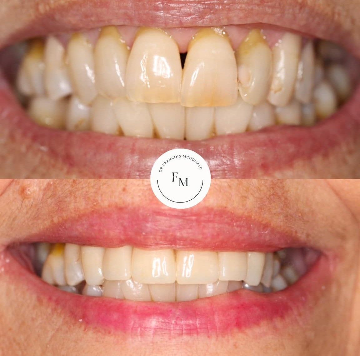 A Before and After Picture of a Woman 's Teeth — Coronation House Dentist in Nambour, QLD
