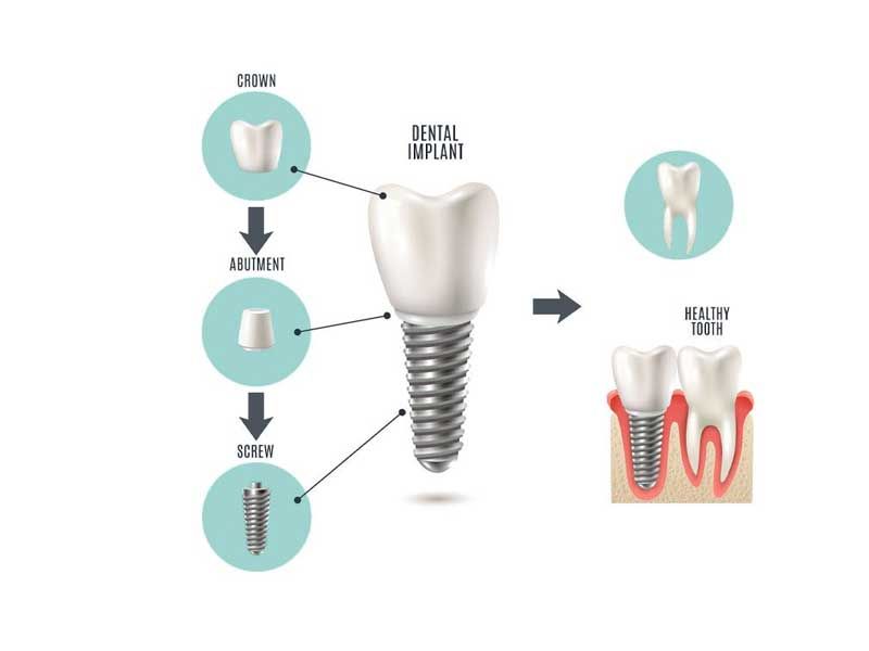A Woman is Smiling and Looking at Her Teeth Through a Magnifying Glass — Coronation House Dentist in Nambour, QLD