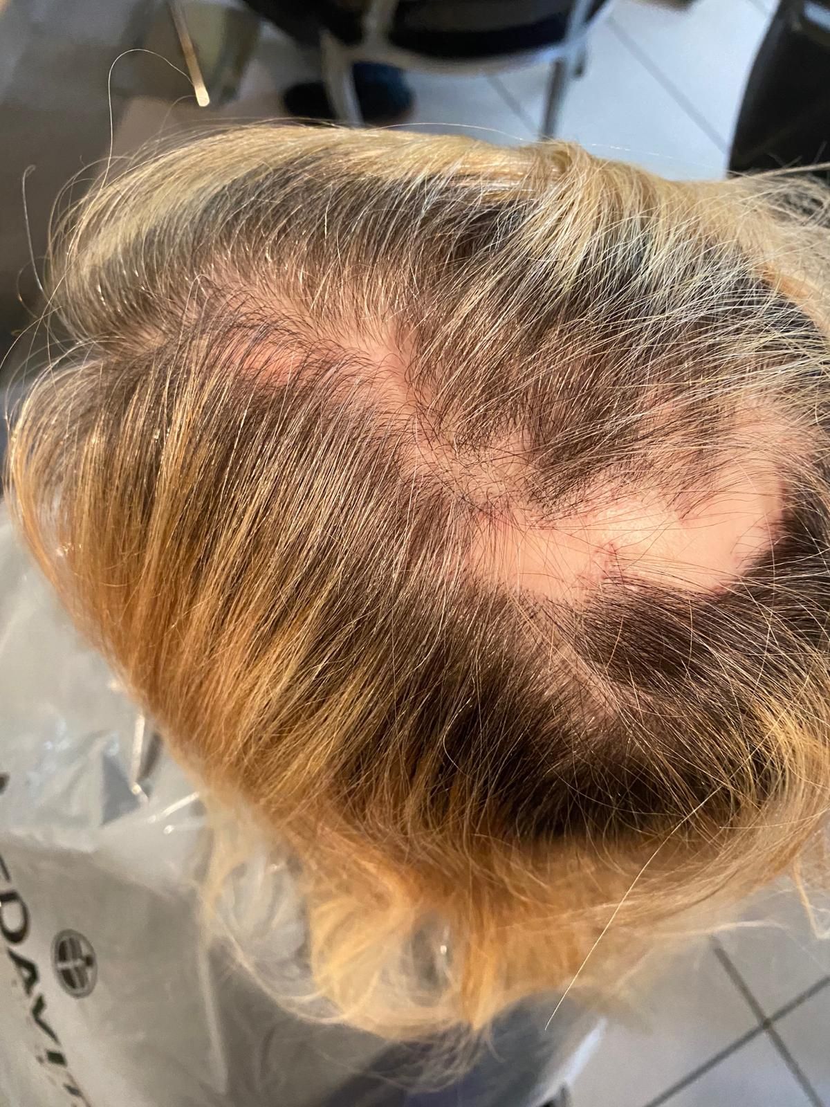 Un primo piano della testa di una donna con una chiazza calva.