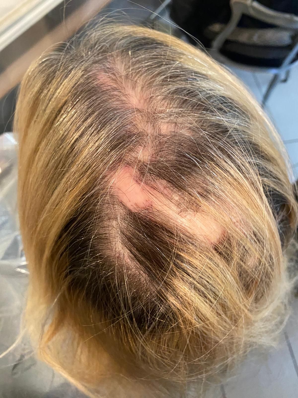 Un primo piano della testa di una donna con una chiazza calva.