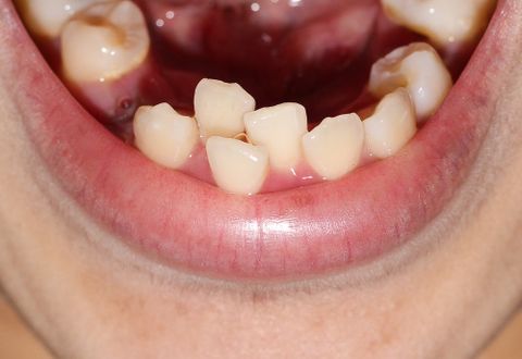 Dr. Young Nam Kim Orthodontist | What causes crowded teeth