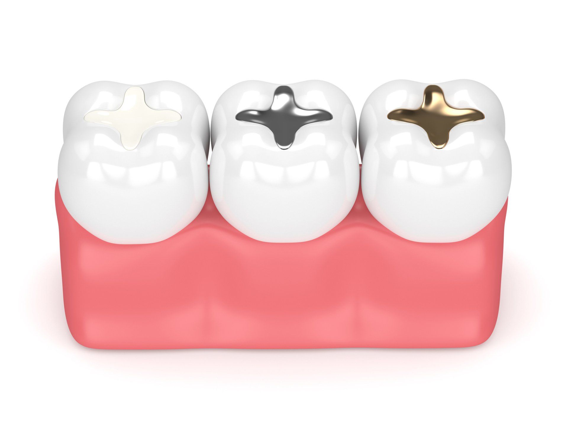 Composite Fillings Process — Greenville, NC — Natalie B. McCarthy, DDS, PA