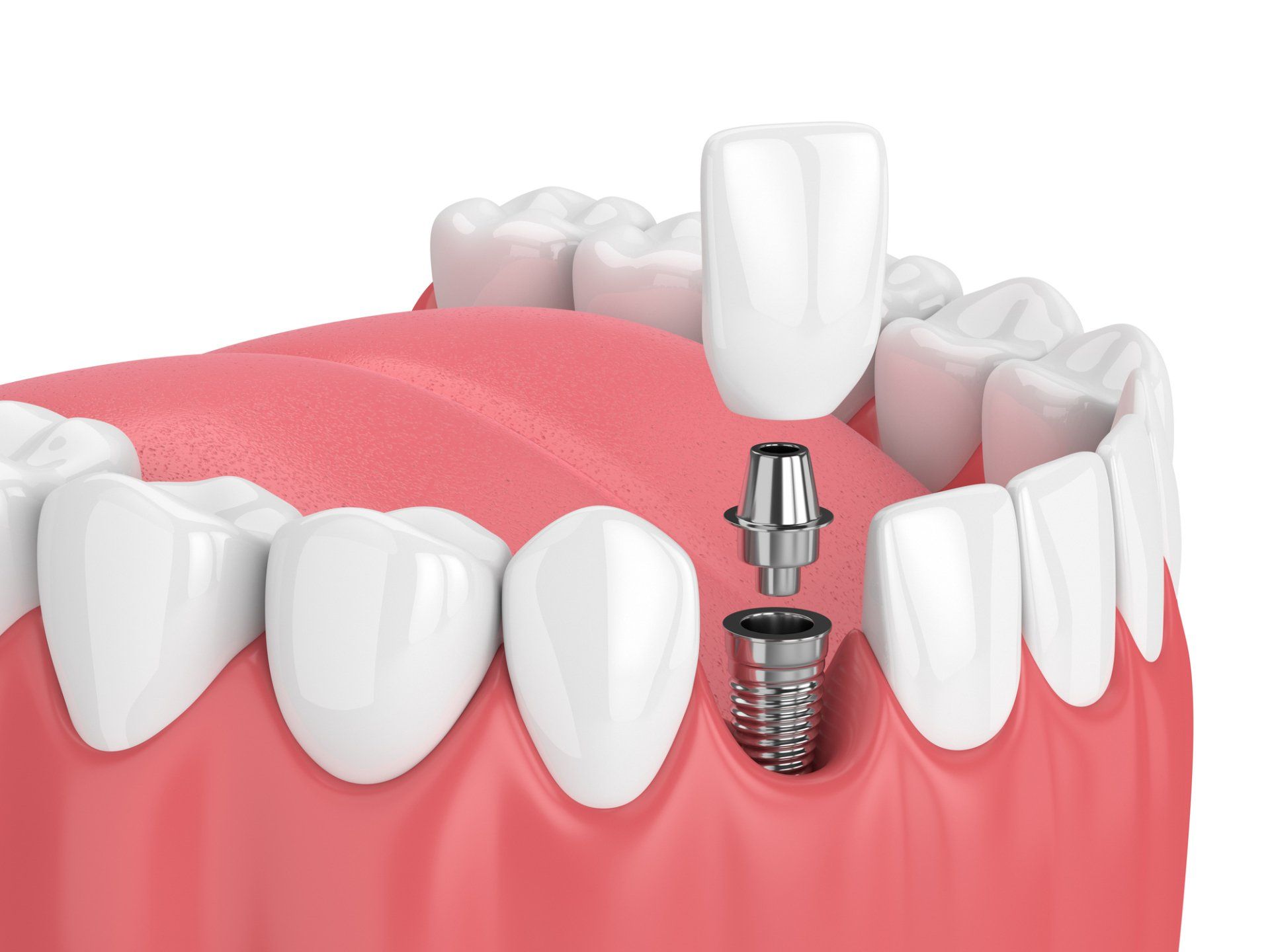 Dental Implants Process Image — Greenville, NC — Natalie B. McCarthy, DDS, PA