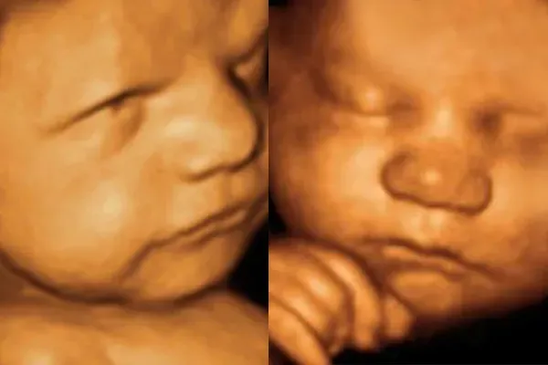 side by side images of a baby's face in utero