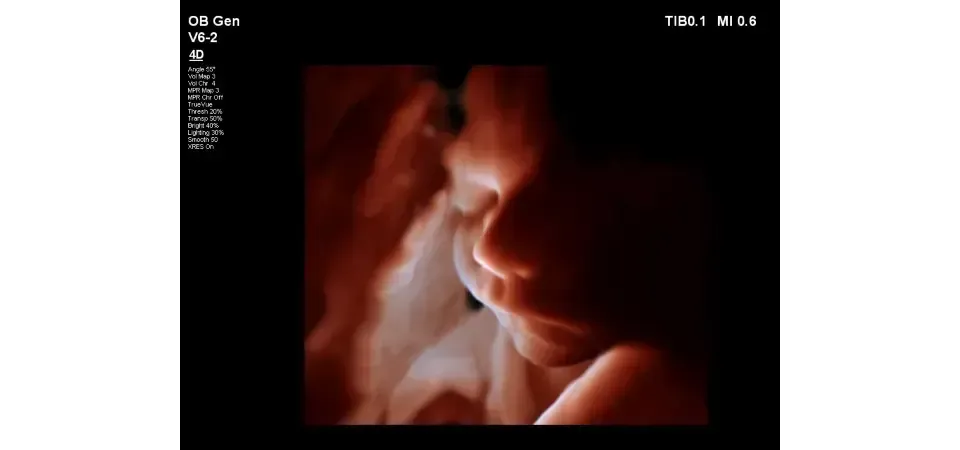 in utero baby face on Philips EPIQ 7
ultrasound screen