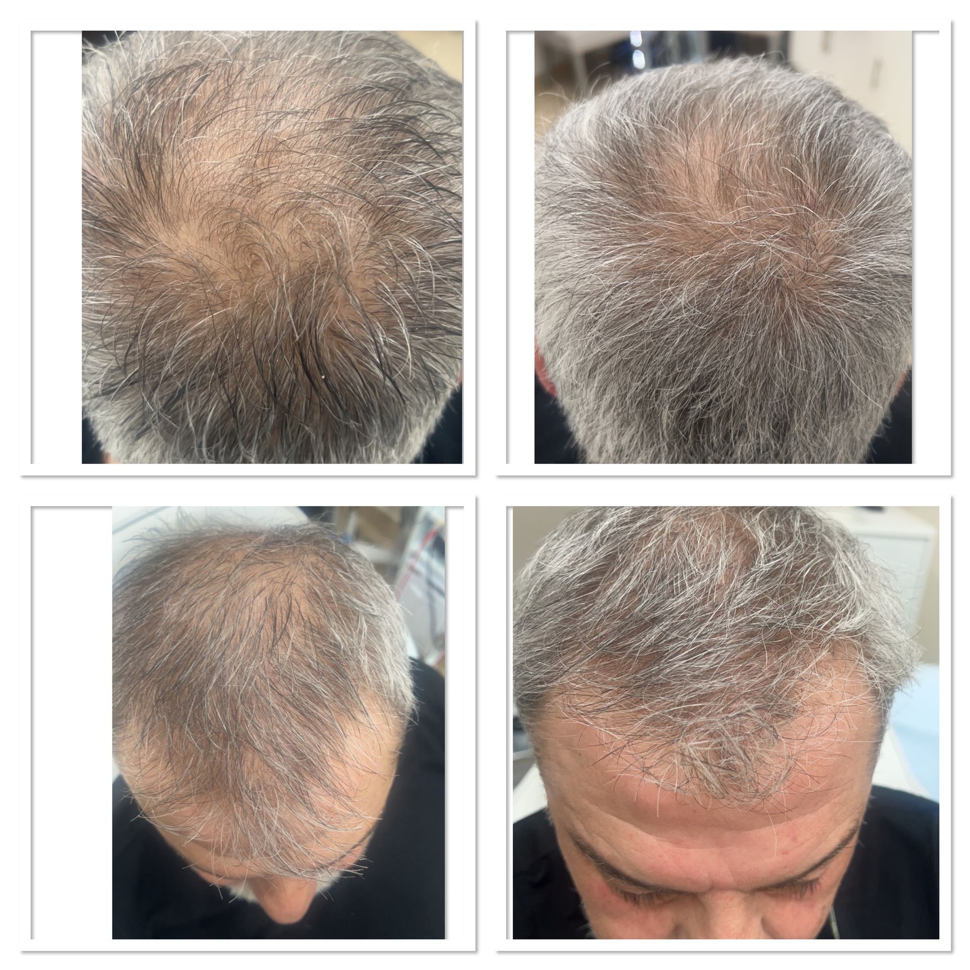 A collage of four pictures of a man 's head with gray hair.