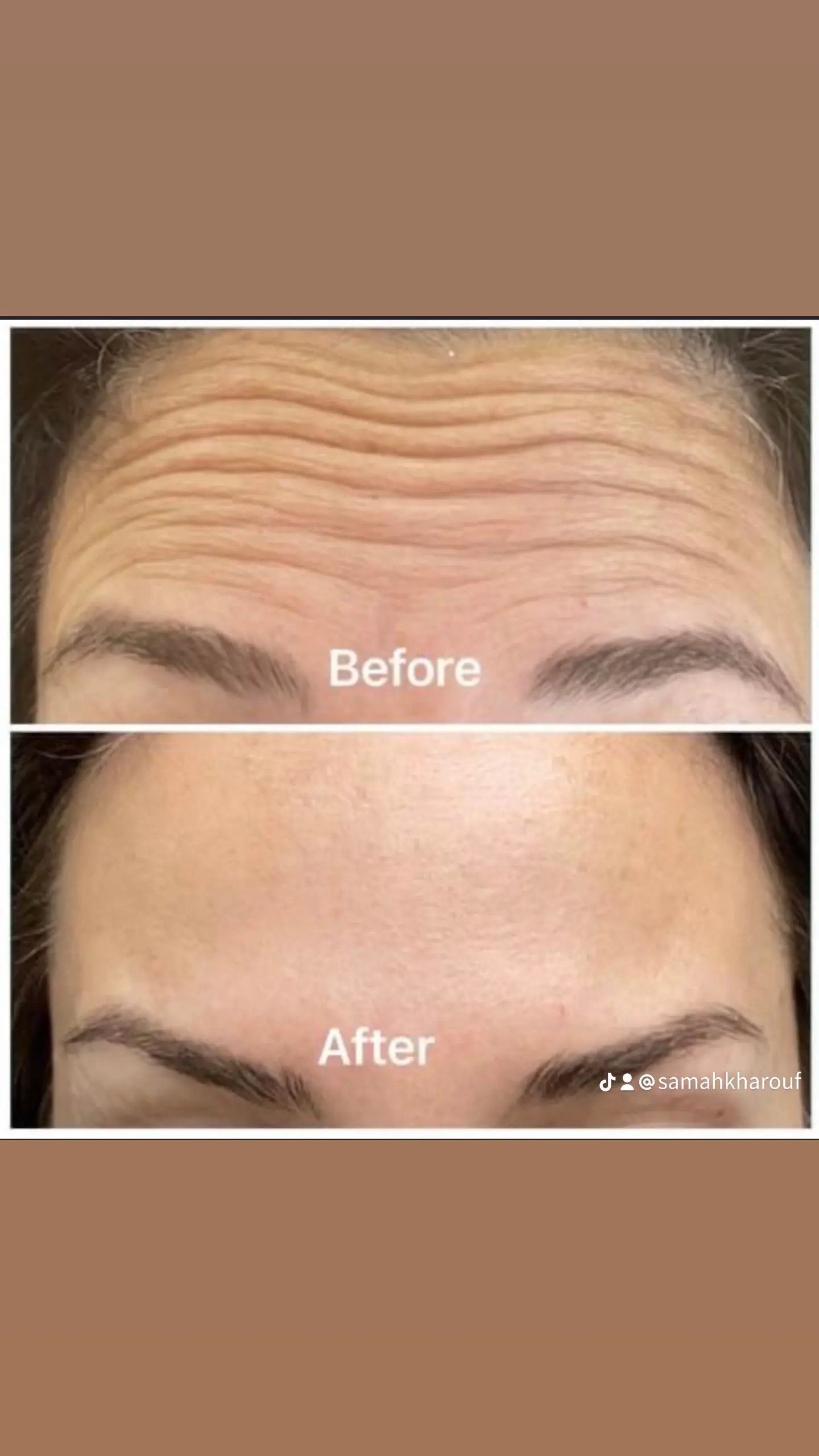 A before and after picture of a woman 's forehead with wrinkles.