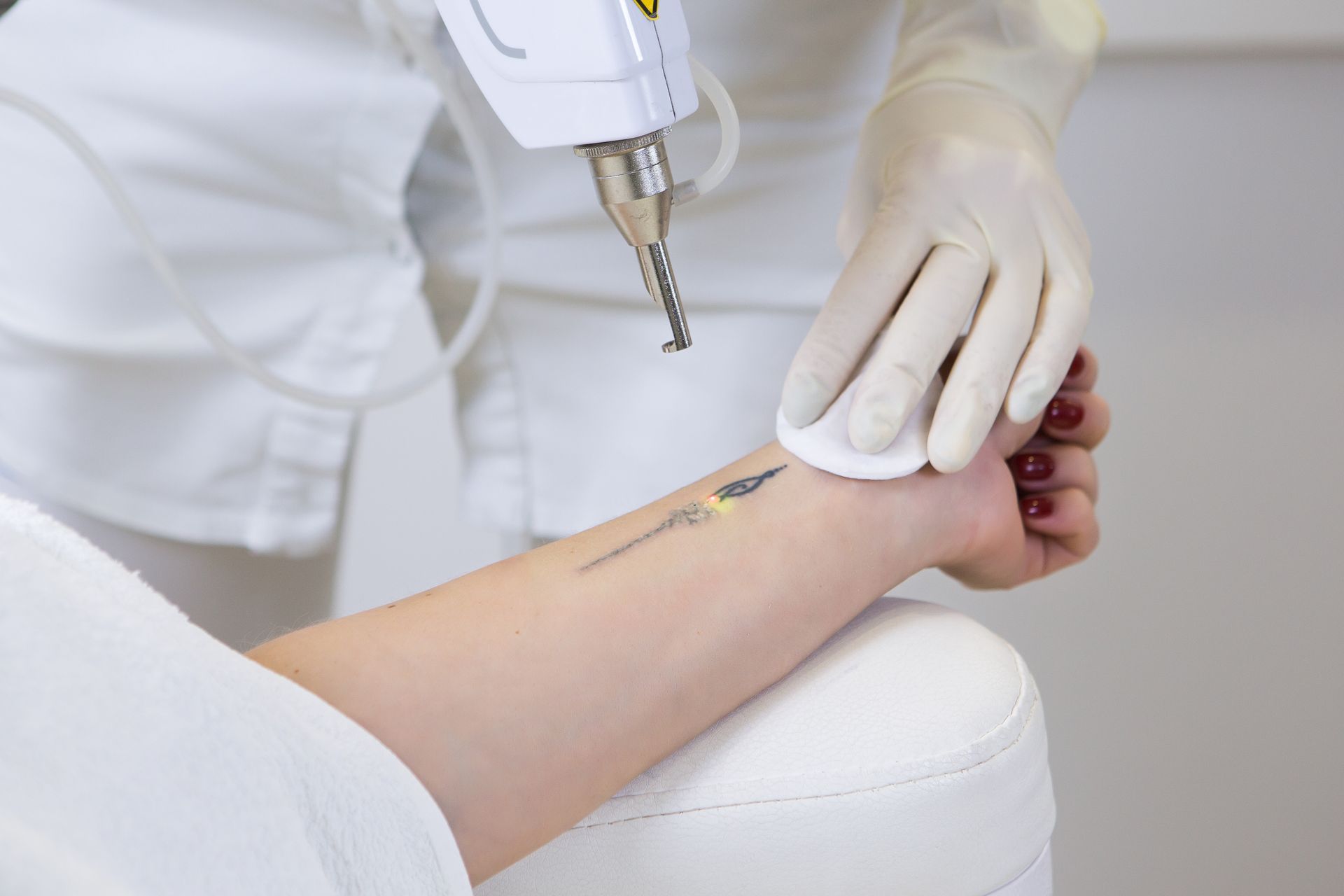 A woman is getting a tattoo removed from her arm.