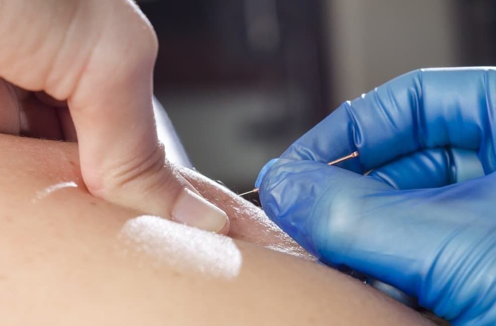 A Hand In Blue Gloves Inserting A Thin Needle Into A Person's Skin — Integrate Health In Moranbah, QLD