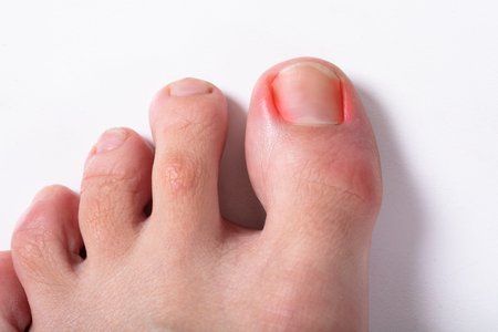 mild ingrown toenail