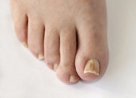 Patients with Diabetes: Take Toenail Fungus Seriously